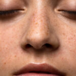 dark spots treatment